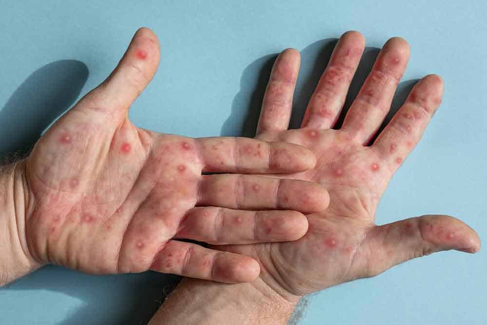 More dangerous mpox variant not among 4 confirmed Mississauga and ...